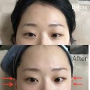 7623 | 마곡피부관리 | 시그니처 에스테틱 1회만으로 옆광대와 리프팅 자세한 순서 후기