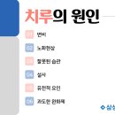 치루개 이미지