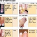 발톱색깔 엄지 발톱 손톱 세로줄 원인 방치하면 위험 이미지
