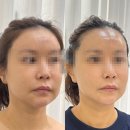 CU(상남더센텀점) | 해운대 피부관리 센텀 페이슬림 알테온 리프팅후기