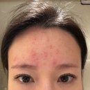 휴한의원 | 강남역 피부과 추천 &#39;트러블 컨택터&#39; 한의원 피부과 턱여드름 치료 받고온 내돈내산 후기