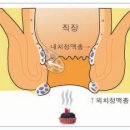 치질과 한방요법 이미지