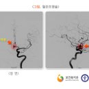 뇌졸중 이미지