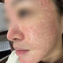 릴리브의원 | 압구정 무통 리쥬란힐러 내돈내산 후기