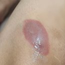 미보약국 | 고데기 화상 크림 미보 연고 4주 후기 + 회복 과정