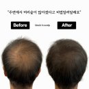 블랙인스칼프 | 대구정수리두피문신 신중하게 결정한 전문업체 블랙인스칼프 후기