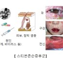 용해반점 이미지