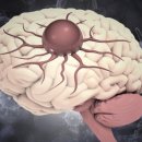 뇌종양의 징조, 두통·시력저하·기억장애 이미지