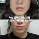 브이핏 | 부산 윤곽주사 브이핏 브이올렛주사 내돈내산 후기