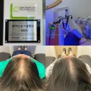 (주)칸메디 | 대구 30대 여성탈모관리 라파드 두피탈모센터 대구본점 8회차 관리후기