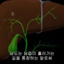 담도암 cholangiocarcinoma 이미지