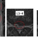 허리마니아파 님의 요추디스크 L4-5, L5-S1의 MRI 사진입니다. 이미지