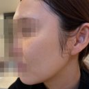 삐삐휴게점 | 서울 압구정로데오역 루나의원 루비레이저 후기 (또 다시 말괄량이 삐삐 일상,,)