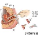 자궁경부암 조직검사 자궁경부암 자궁경부암 발생 방법 이미지