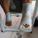 양산 부산대 어린이 병원 왼쪽발 합지증 오른쪽발 점제거 수술 이미지