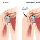 유착성 관절낭염(오십견, 동결견; Frozen Shoulder) 이미지