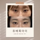 스킨아이 | 홍대 피부과 스킨부스터 쥬베룩아이 후기 눈밑고랑 내돈내산