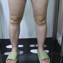 더행복한흉부외과의원 | 하지정맥류잘하는곳은 갱년기 하지정맥류 다르게 치료합니다_더행복한흉부외과