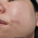 좋은비타민 성심 | 30대 얼굴 기저세포암 수술 후 2개월 경과｜흉터 변화, 통증, 재생 과정 솔직 후기