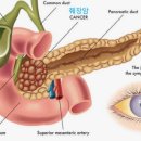 췌장암 미리 발견할 수 있는 방법 이미지