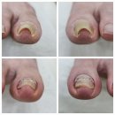 치유네일레푸스양재점 | 강남내성발톱 레푸스 양재점에서 해결한 후기