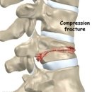 압박골절 (compression fracture) 이미지