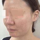 구래동 여드름 압출 봄맞이필링 극지성 피부 관리 후기