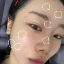 지오성형외과 | 신사역 리본성형외과 콜라겐 스킨부스터 당기지오 후기(리쥬란과 비교)