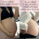 11305-12-3-37 | 초상모 응급 제왕절개 출산후기 | 37주4일 갑작스러운 임신중독증 증상으로 출산
