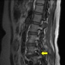 척추 분리증 spondylolysis 이미지