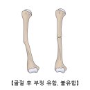 골절후 부정유합,불유합 (Malunion &amp; nonunion of fracture)근 골격질환 이란? 이미지