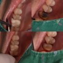 리라치과의원 | 크라운 수명이 다되어서 치아크라운 교체하는게 쉽지는 않습니다. 치과 치료 기본의 중요성