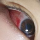 대치연세안과의원 | 잠실SU연세안과의원 내돈내산 후기 | 인생 첫 다래끼 짜기..