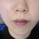 하남예쁨주의쁨의원 | 미사역 예쁨주의쁨 피부과 내돈내산 레이저시술