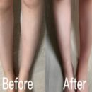 밸런스본의원 | 압구정로데오 유라인의원 지방분해주사 종아리컷주사 5회차 후기