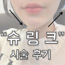 티티성형외과의원 | 첫 슈링크 시술 후기! 강남 "티티 성형외과" 슈링크 300샷 / 슈링크 후기 / 슈링크 효과