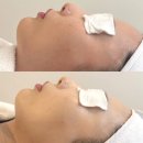 메인메디칼 | 일산피부관리 썸모어뷰티살롱 메디컬 스킨플래닝 깐달걀피부 후기