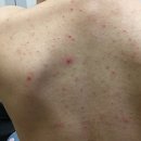 덕인약국 | 등드름 흉터 연고 내돈내산 약국 크림으로 한방에 정리한 후기공유