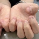내손톱내발톱 | 성수동 물어뜯는 손톱 발톱 교정 네일은청담 후기