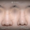 포커스성형외과의원 | 공간성형외과 남자매부리코성형후기 케이스 리뷰#60