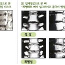 [퇴행성디스크] 퇴행성디스크의 진단법! 나도 혹시 퇴행성디스크? 이미지