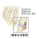 [건강상식]통풍 (Gout) 이미지