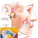 뇌척주관절장애(FCSJ Disorder) 이미지