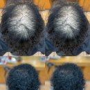 여성탈모 흑채로버틴진난날 토탈탈모교정펌으로 풍성한느좋여자로 재탄생 르네시떼미용실부산사상헤어샵/ 북구사상구해운대구김해영도구수영구금정구북구 이미지