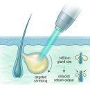 이윤형 | 하남여드름 네오빔 레이저 후기 때문에 망설여진다면