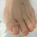 메디타워 | 군포발톱무좀 전문샵 후기 풋네일 동성제약 풀리메디 군포산본점