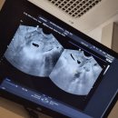 아라의원 | [서브병원:아라서울여성의원] 임신초기 5주3일 난황 확인 (feat. 쌍둥이, 임신확인서)