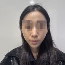 절골 | 논현역성형외과 무보형물코수술 절골 후기 통증 붓기 1개월차