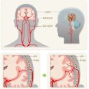 뇌혈관질환 분류표와 특정뇌혈관질환 분류표의 비교 이미지