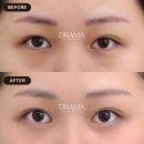 드라마성형외과의원 | 30대 눈밑 지방 타파 끝판왕, 드라마성형외과 이승국 원장 '눈밑지우개' 리얼 후기 | 한달차